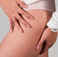 Fibroplasma Stretch Mark Treatment | Improves Texture, Tone & Skin Elasticity