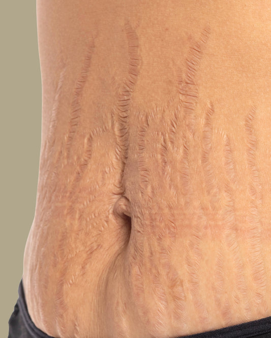 Tratamiento para estrías abdomen bajo