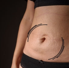 Tratamiento estrías abdomen bajo, Plasma pen