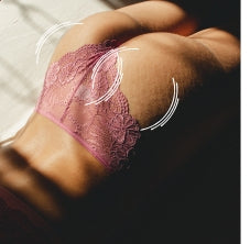 Tratamiento estrías gluteo parte superior, Plasma pen