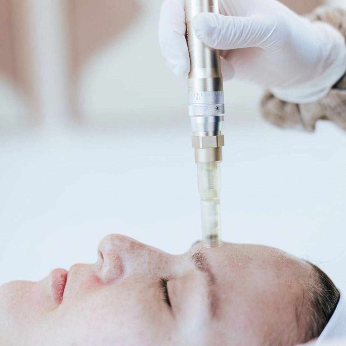 Microagujas Facial