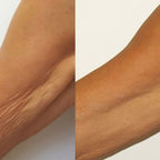 Tratamiento de plasma de fibroblastos para la piel – Antebrazos