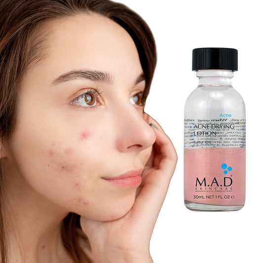 Acne Drying Lotion