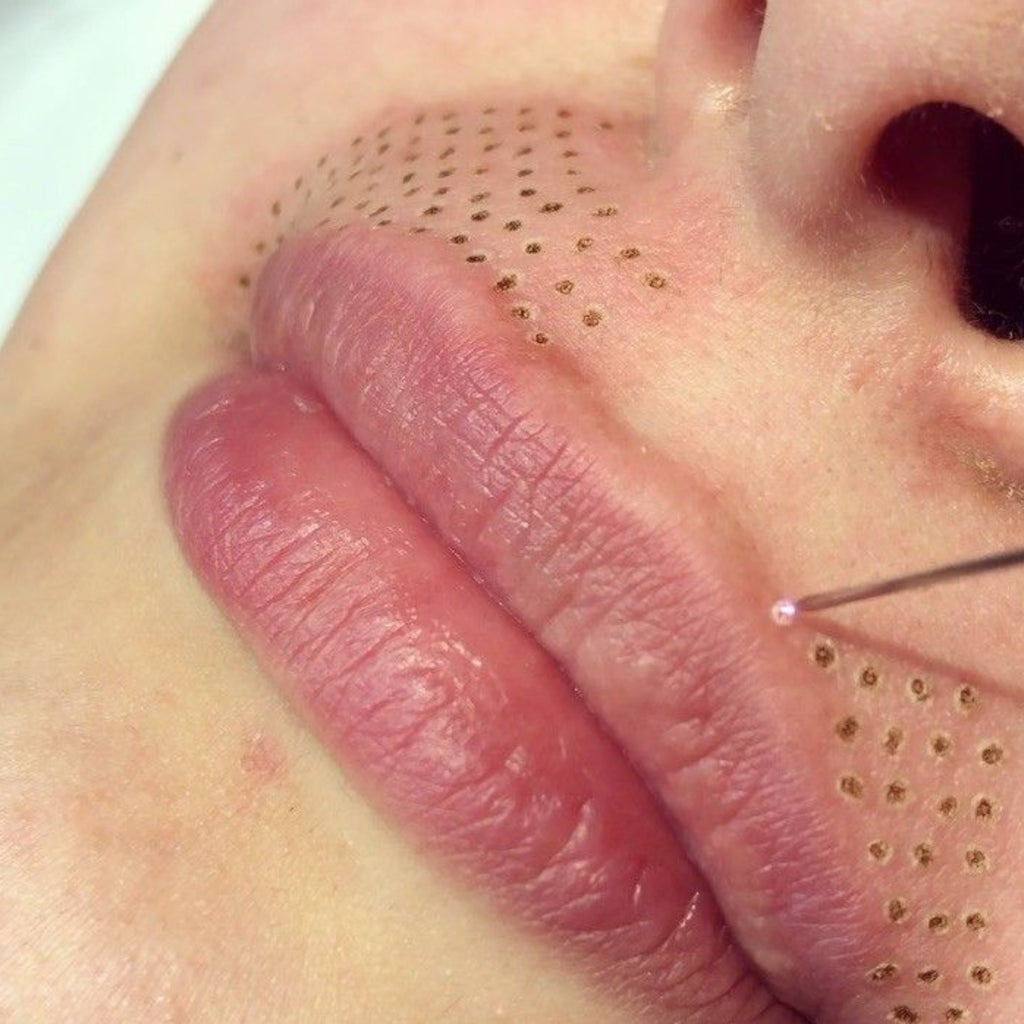 Tratamiento de código de barra labios con plasma de fibroblastos | Tensado y lifting cutáneo no quirúrgico