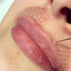 Tratamiento de código de barra labios con plasma de fibroblastos | Tensado y lifting cutáneo no quirúrgico
