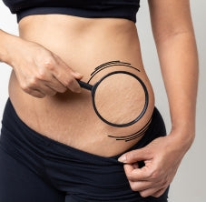 Tratamiento estrías abdomen completo, plasma pen